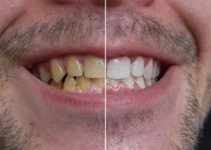 enlever tache tabac sur les dents