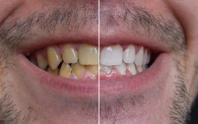 enlever tache tabac sur les dents